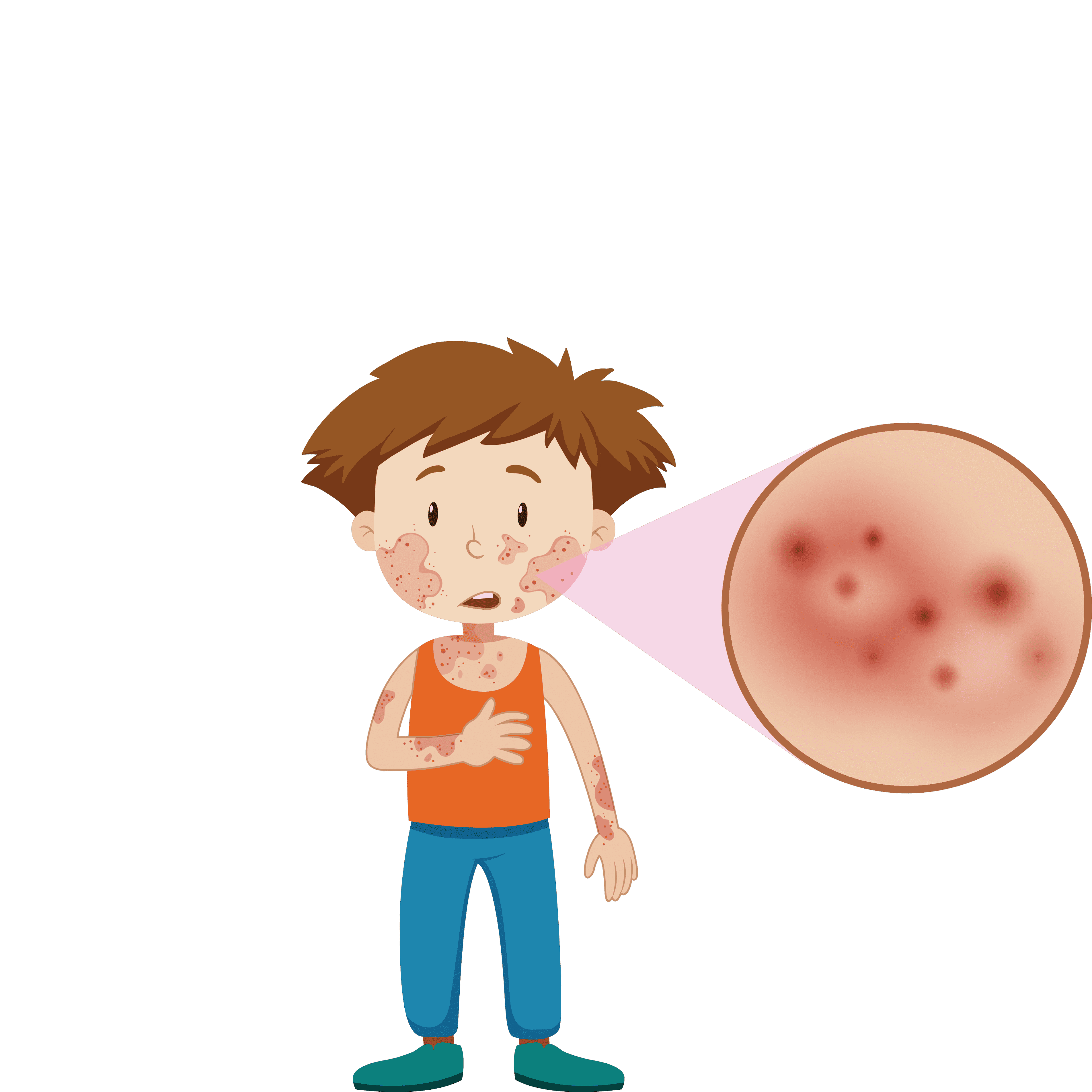 eczema-ayurvedic-treatment