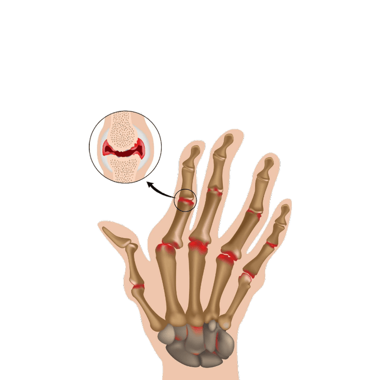 ayurvedic-arthritis-treatment